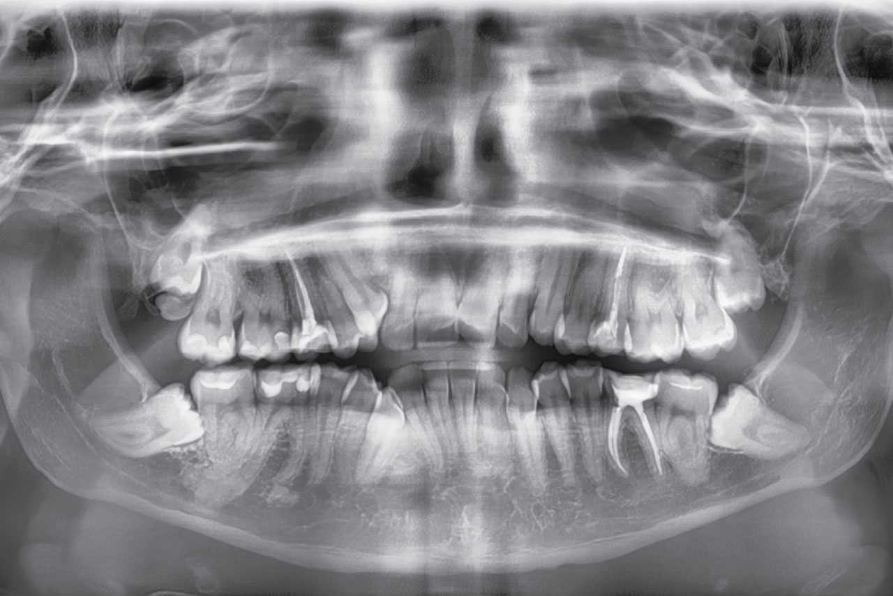 denti del giudizio senza traumi cagliari white